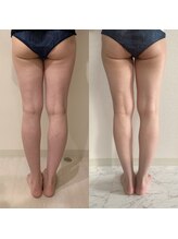 エイティ(Atey)/脂肪冷却