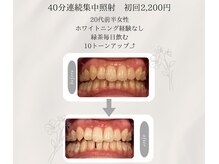 プラスビーセルフ(+b self)/ホワイトニングビフォーアフター