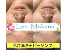 レアマカナ(LeaMakana)/毛穴洗浄＋ピーリング