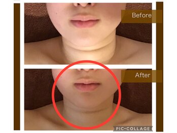 サロンドボーテ ヴィクトワール マルヤマ(Salon de beaute VICTOIRE MARUYAMA)/フェイシャル+首周り/キャビ