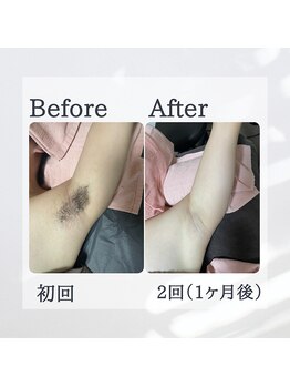 ティグレ 岡山店(TIGRE)/メンズ全身脱毛(顔VIO込)