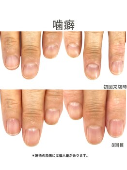 50代/保育士/噛癖