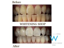 ホワイトニングショップ 甲賀店/Before&After『ホワイトニング』