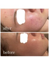 ブリス(BLiSS)/水素クレンジング