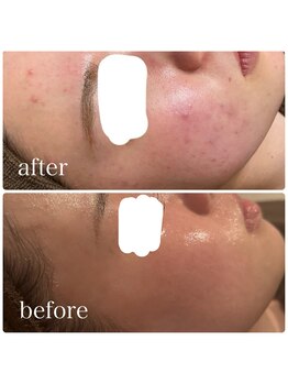 ブリス(BLiSS)/水素クレンジング