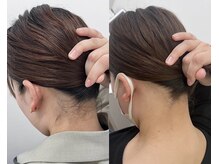 ミース 名古屋駅前店/ ★うなじ脱毛BeforeAfter