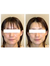 ビーサロン(B-salon)/リフトアップ/テラボーラー