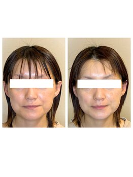 ビーサロン(B-salon)/リフトアップ/テラボーラー