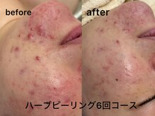 リノレア(Lino_Lea)の雰囲気（ニキビ・赤みには剥離なしのハーブピーリング！敏感肌も対応◎）