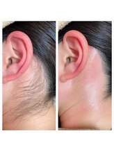 サロンアンドスクール ローズマリー (Salon&School Rosemary)/うなじワックス¥3300光併用¥4950