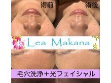 レアマカナ(LeaMakana)/毛穴洗浄＋光フェイシャル