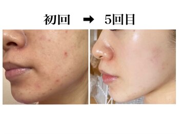 アレーズファイブフォー(A’LAISE54)/ニキビケア２０代女性