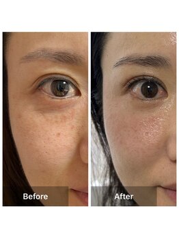 サロン ド アヤ(salon de Aya)/３ヶ月でシワ・シミの改善