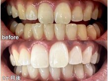 グラーティア 奈良王寺店/ホワイトニング★2ヶ月目★