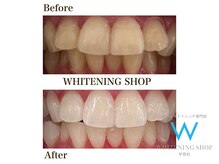 ホワイトニングショップ 甲賀店/Before&After『ホワイトニング』