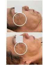 エステサロンパリス(Esthe Salon Paris)/純粋レチノールフェイシャル