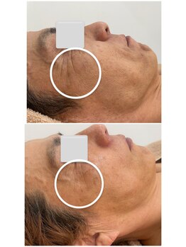 エステサロンパリス(Esthe Salon Paris)/純粋レチノールフェイシャル