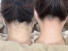 リグレイス(Re.Grace)/うなじ脱毛