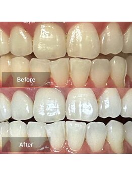 サン(SAN)/ホワイトニングB/A