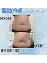 ユアーズ ビューティー(YOURS beauty)/脂肪冷却