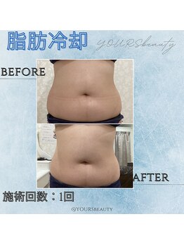 ユアーズ ビューティー(YOURS beauty)/脂肪冷却