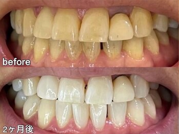 グラーティア 奈良王寺店/ホワイトニング★2ヶ月目★