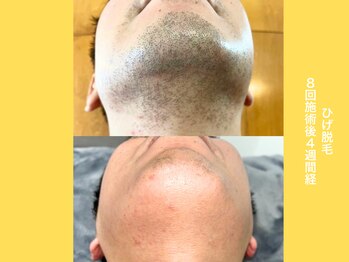 エクレ 柏店(EKURE)/ヒゲ脱毛