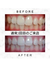 エミリアホワイトニング(EMIRIA WHITENING)/Before/After