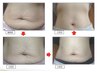 【当店最高峰】高濃度痩身セラムで脂肪にアプローチ!ボディライン激変 2部位