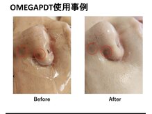 アオヤマ サロン ワイゼット(AOYAMA SALON YZ)/鼻の毛穴ケア