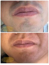 アン リオン(UN LiON)/顔全体20回