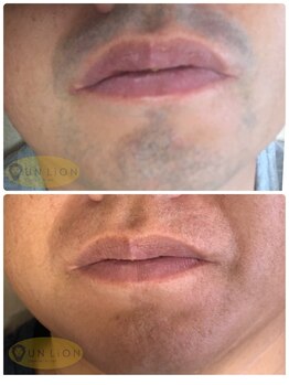 アン リオン(UN LiON)/顔全体20回