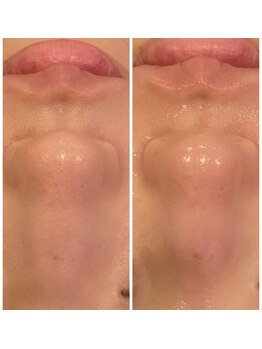 うつくし痩身 美サロン ゼットワン(Z-ONE)/ハイドロスプラッシュ