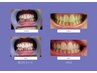 (メンズ専用)【都度払い】本気で白い歯になりたい方必見!!1回でトーンUP実感!