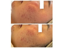 ミニマル(minimal)/ピーリング