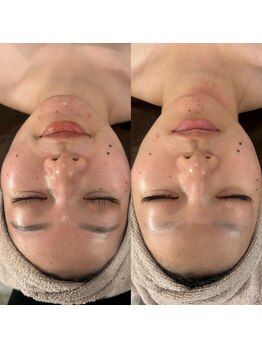 ラナ 京都西院店(Lana)/次世代ピーリング