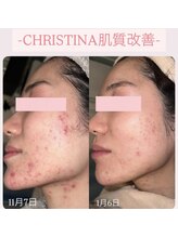 リファラ 光の森店(REFALA)/毛穴・ニキビケア専門REFALA