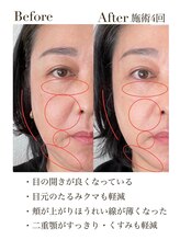 メイ フェアリー 銀座エクステ ネイルサロン(May Fairy)/VAR ビフォーアフター