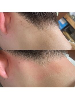 エミュ(emu)/うなじ美人wax脱毛♪