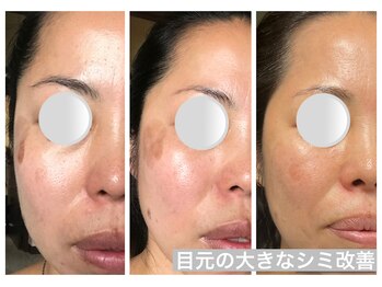 Hb 与野/シミ　ホームケア事例