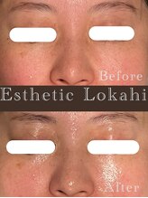 ロカヒ(Lokahi)/目元の小ジワ撲滅！！