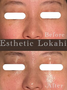 ロカヒ(Lokahi)/目元の小ジワ撲滅!!