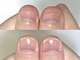 フェミニンネイル(Feminine Nail)の写真/諦めていたネイルをもう一度!コンプレックスに対応し、自爪育成でちび爪/深爪/2枚爪/薄い爪/噛爪をケア★