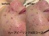 【人気NO2/オープン記念】ニキビ・肌荒れ◎剥離なしハーブピーリング¥8,800