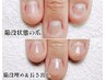 甘皮処理付～【陥没深爪改善スカルプ】☆100分￥9500