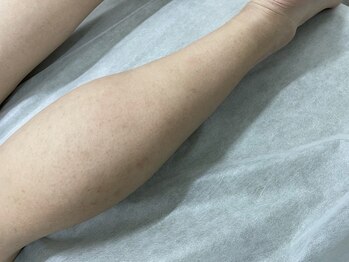 ナノハナ/鹿沼市の全身脱毛美容室ナノハナ