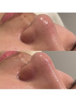 ミューズ(MUSE)/毛穴エクストラクション＋顔脱毛