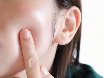 レアマカナ(LeaMakana)の写真/【マイクロニードルピーリングで肌質改善♪】繰り返す大人ニキビにお悩みの方に!揺らぎがちな肌もお任せ!