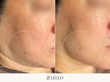 レロ 恵比寿店(LELLO)/エイジングケアが得意な施術です