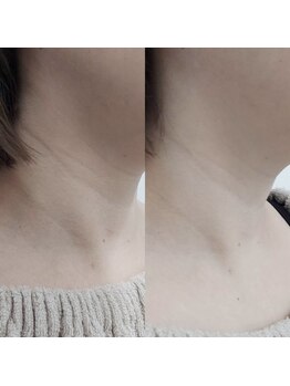 ヴェルシック(Belchic)/首のシワ改善も可能